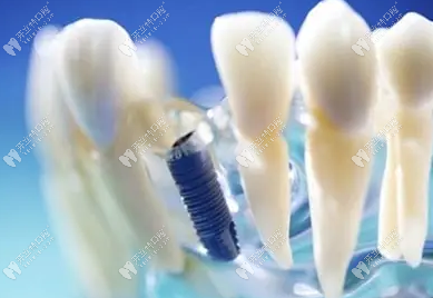 <!--<i data=20240703-sp></i>-->口腔顧冬輝醫(yī)生種植牙