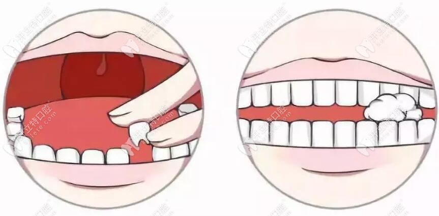 牙齿折法图片