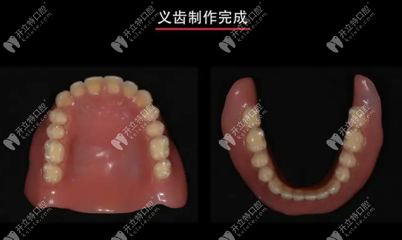 缺几颗牙能不能做BPS吸附性义齿呢
