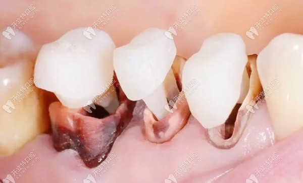 牙齿打桩的过程图片图片