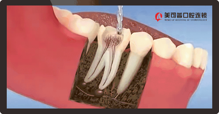 数字化牙体牙髓根管治疗