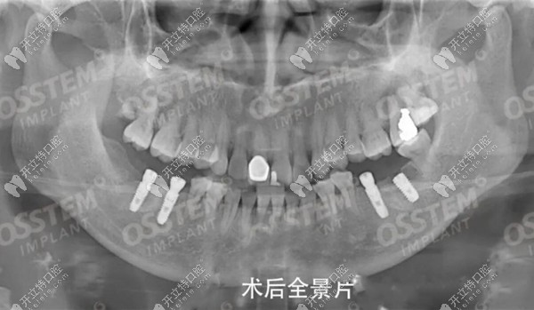 牙齿矫正和种植同时进行的病例