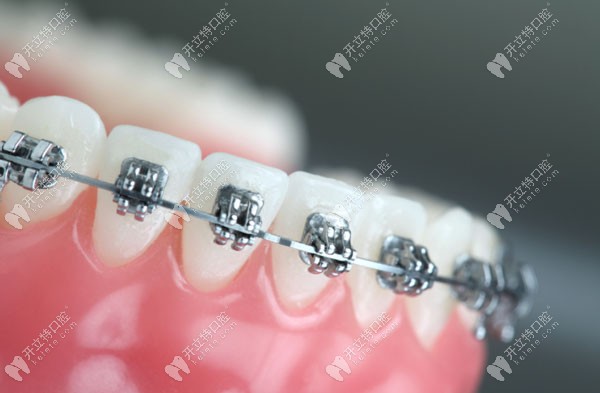 齿性问题是可通过牙齿矫正改善