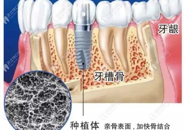 植体与牙槽骨结合的图