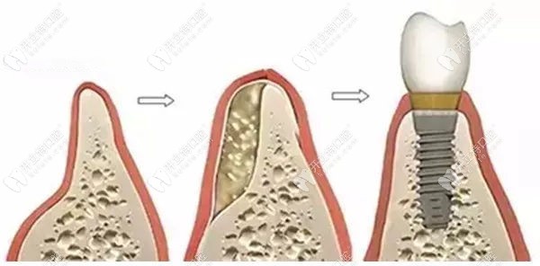 牙槽骨骨量不足同种异体骨移植