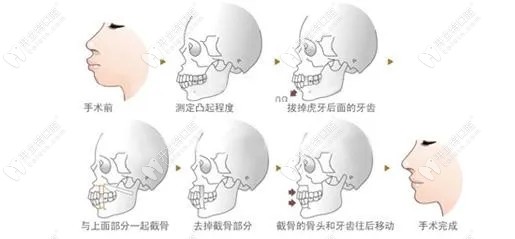 正颌手术步骤及正颌前后对比