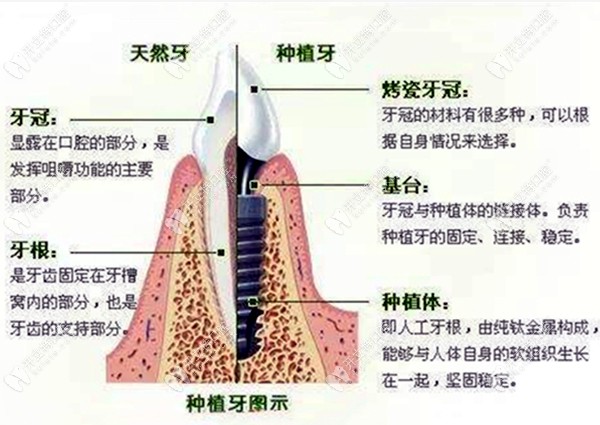 种植牙的示意图