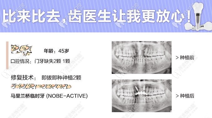 大连齿医生口腔种牙病例