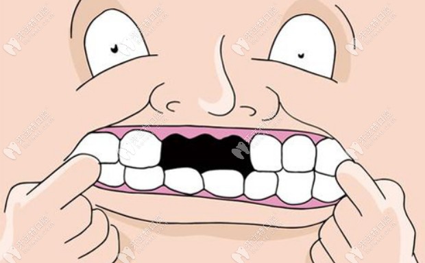 门牙种植牙最快多久可以完成?担心种植过程中没法见人