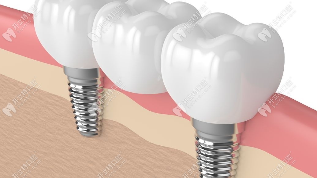 牙槽骨宽度不够可以种植牙吗?话说牙槽骨窄如何种植牙呢