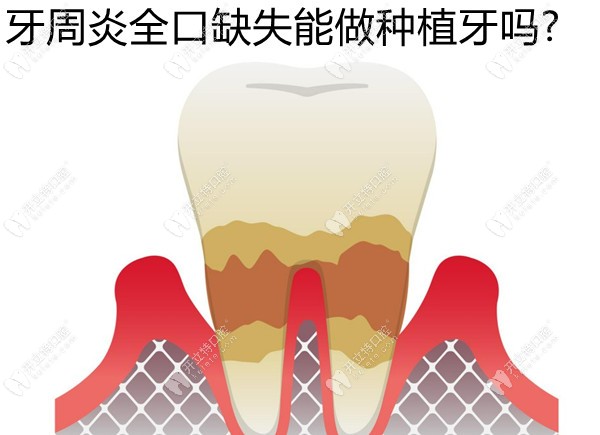 牙周炎全口缺失能做种植牙吗?满口牙周炎+牙骨萎缩患者想问
