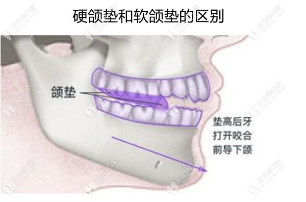 硬颌垫和软颌垫的区别是什么？牙医建议我做正畸颌垫