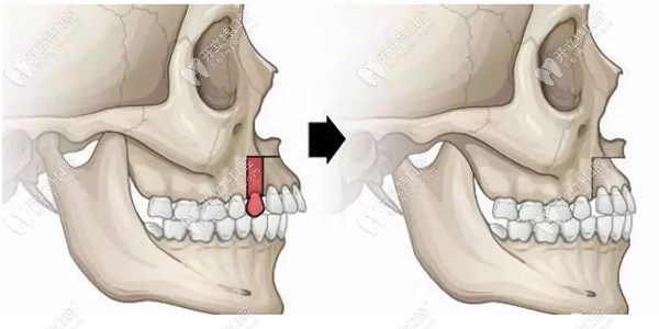 3D数字化导板正颌与普通正颌手术的区别