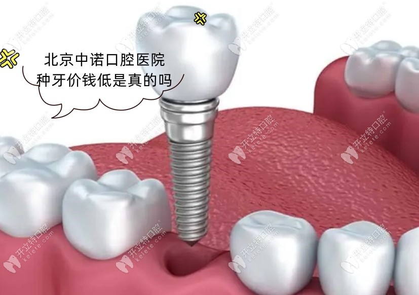 北京中诺口腔医院种植牙价格真低吗