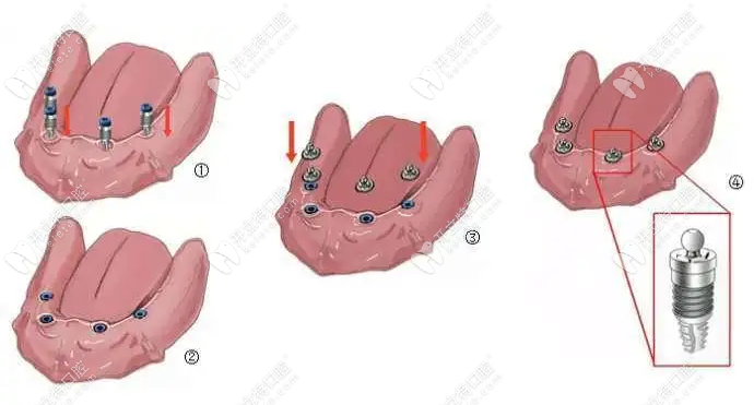 半口半固定种植牙种2和4的区别