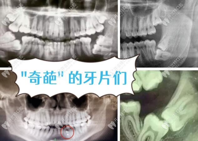 口腔中的小牙片/全景片/头颅侧位片/CT区别以及分别看什么
