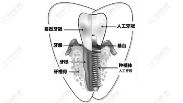 牙周炎种牙选择植体