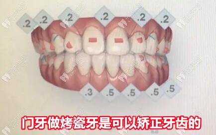门牙烤瓷牙矫正能移动整个牙齿根部