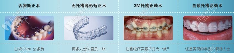 几种常见的牙套种类