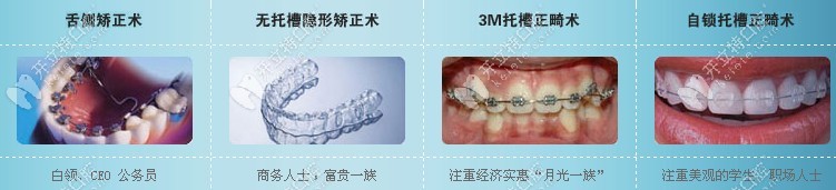 幾種常見的牙套種類