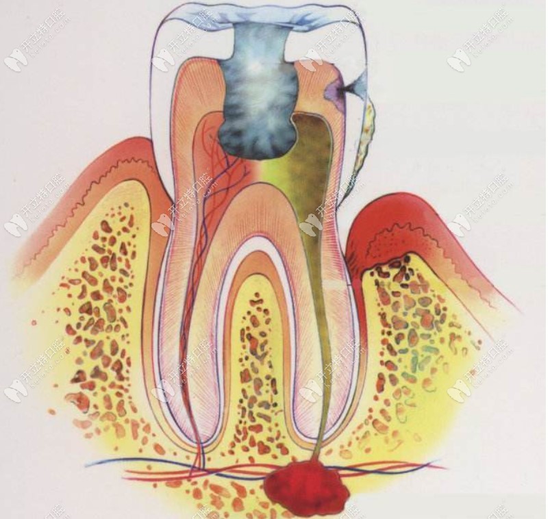 牙髓炎症状表现图片