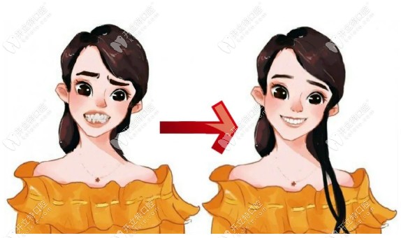 牙齿矫正前后对比图