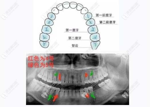 牙齿矫正拔4号牙和5号牙区别大不,拔5号牙正畸时间会更长吗