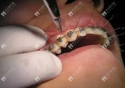 固定金属托槽牙齿矫正中弓丝结扎步骤