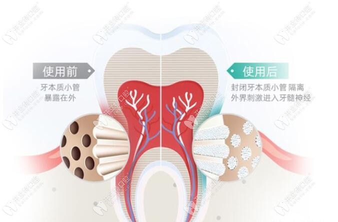 請問牙齒脫敏劑有副作用嗎怎麼有人說脫敏劑會燒傷牙齦