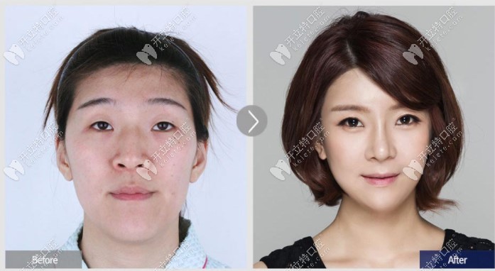 韩国某家医院双鄂手术+轮廓手术后脸型前后对比