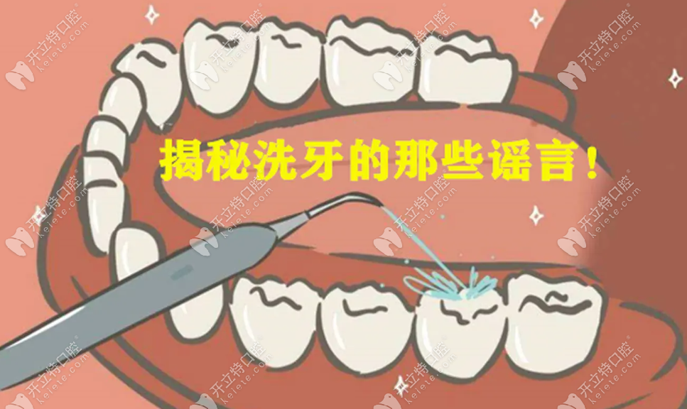 医生不建议清理牙结石是假的,别迷信牙结石自己脱落的谣言