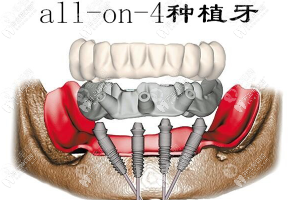 allon4种植技术技术