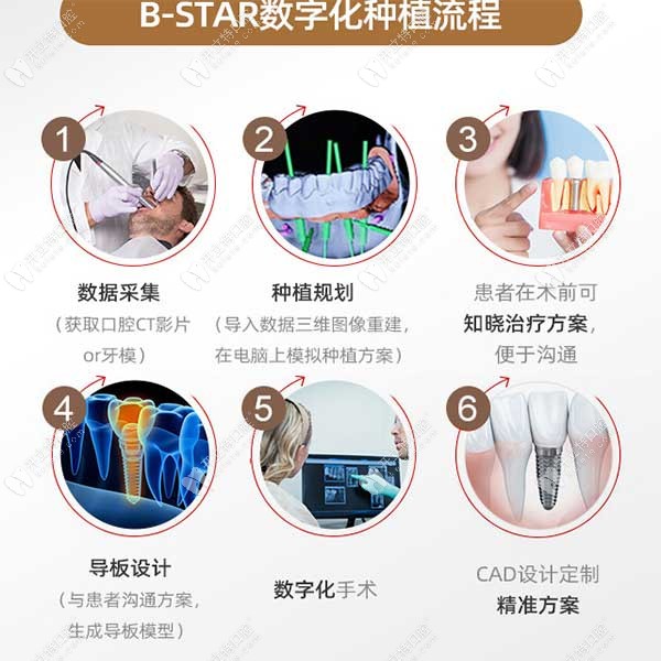 B-STAR数字化种植流程