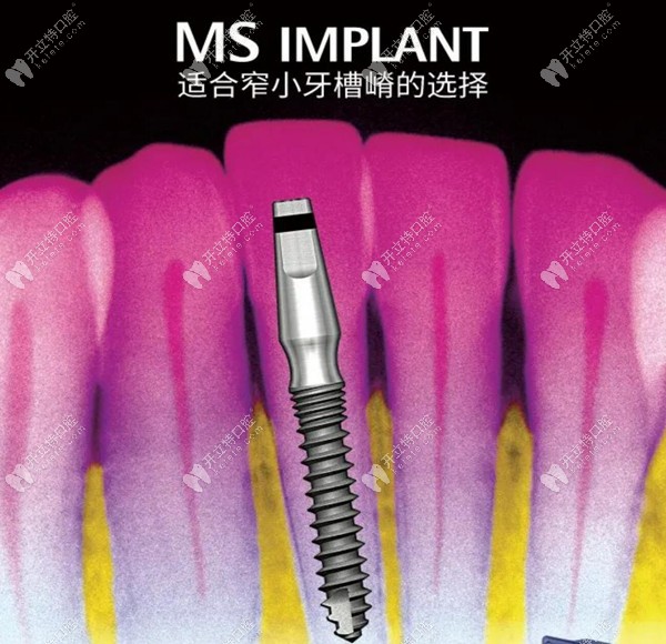 韩国奥齿泰MS Implant迷你种植体