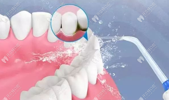 洗牙又被称为龈上洁治术