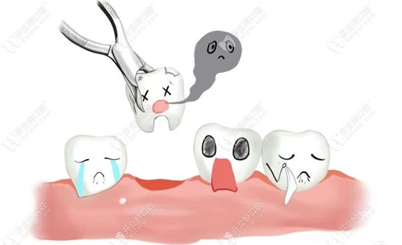 拔牙分为普通拔牙和超声骨刀拔牙