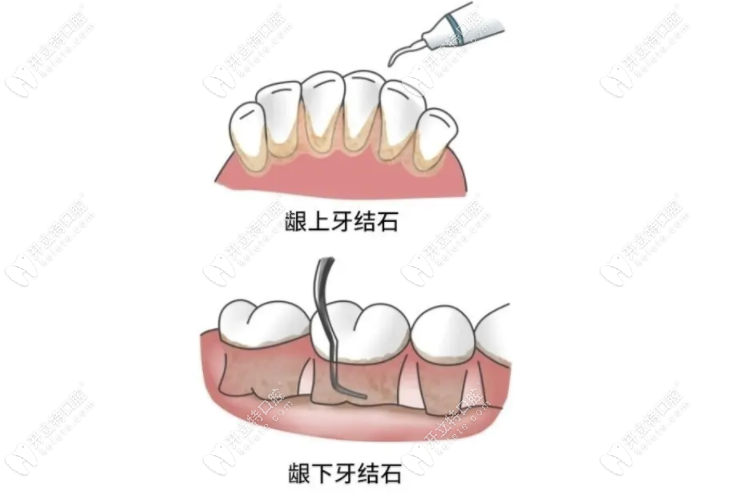 龈上洁牙和龈下刮治的区别