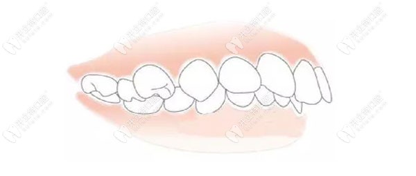 天水做龅牙矫正