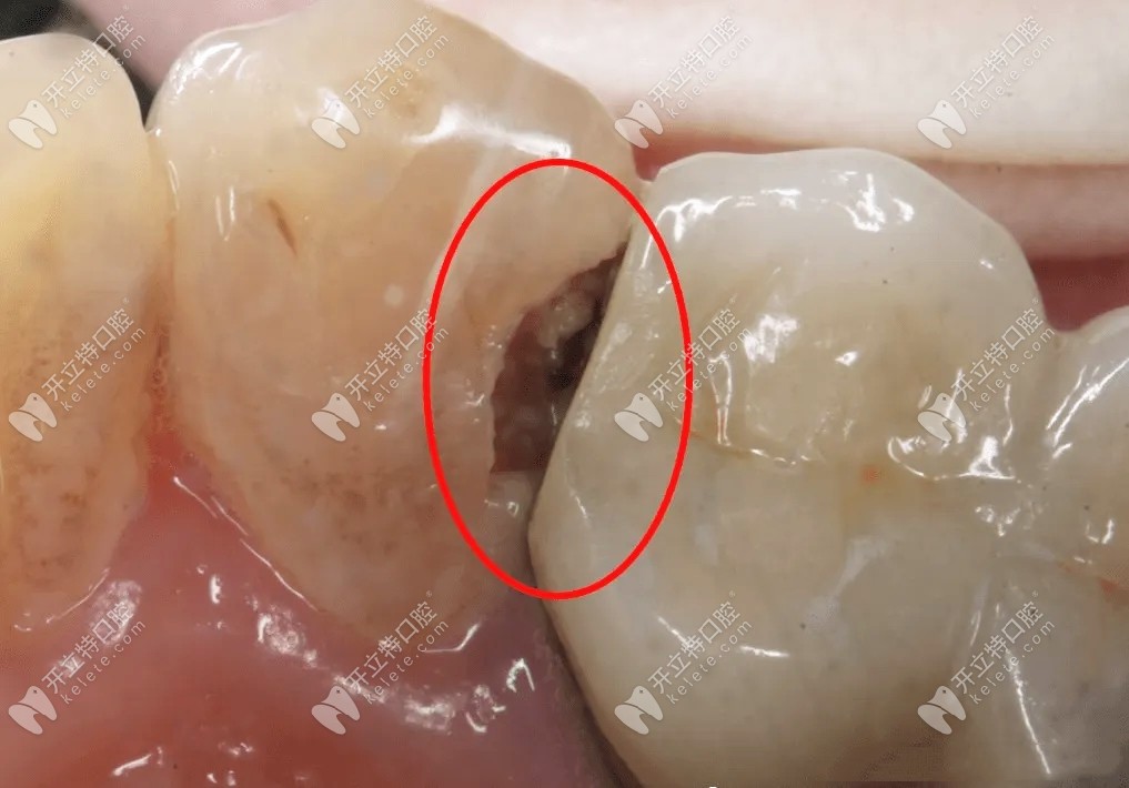 侧面龋是发生在牙齿邻面的龋坏,龋坏位于后牙邻面时,需要制备的窝洞称