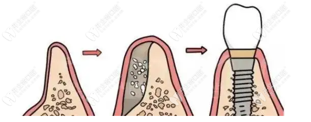 种植牙对骨质的要求
