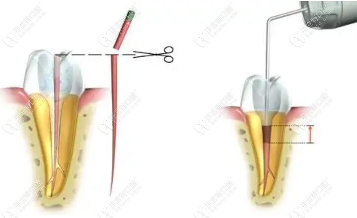 牙根剩4毫米可以做桩冠修复吗?基本治疗过程图解你可以看看