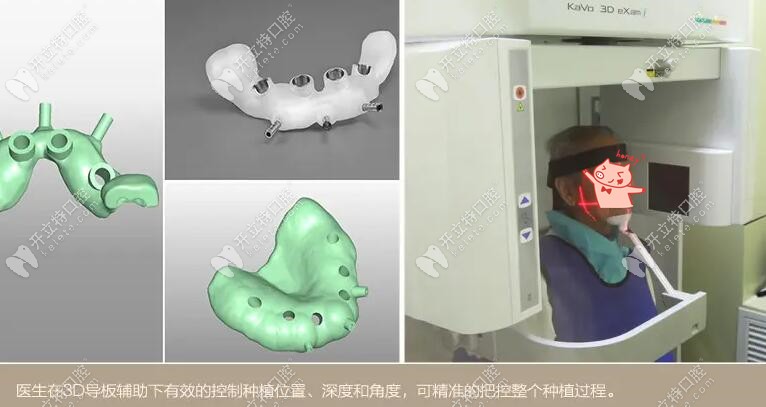 3D数字化导板种植牙流程
