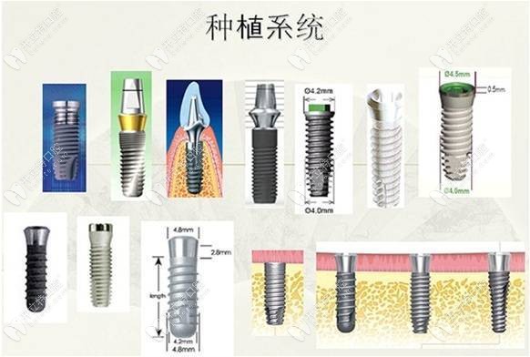 新版种植牙价格表