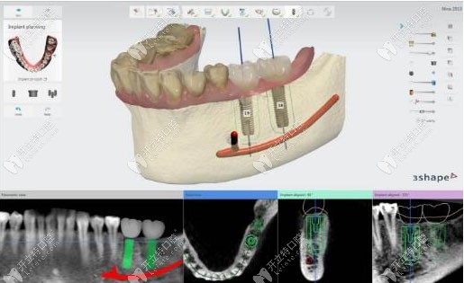 数字化种植牙模拟图