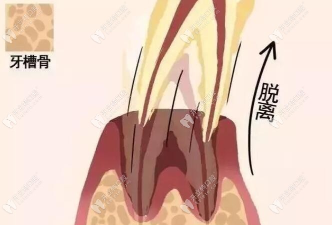 牙周炎、牙髓炎是會造成年輕人牙齒脫落的