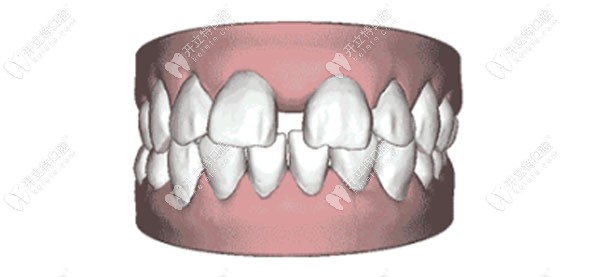 牙缝大一般属于简单病例