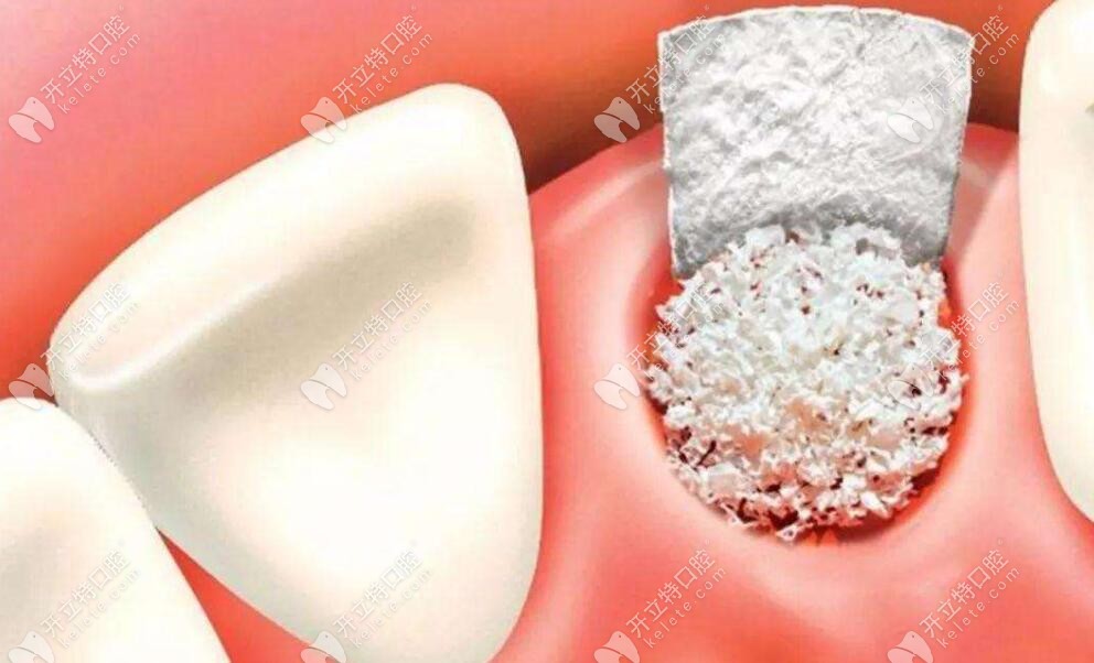 门牙种植不一定加骨粉,前牙区不植骨3d微创种植牙病例分享