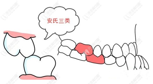 骨性龅牙三类近中错颌表现