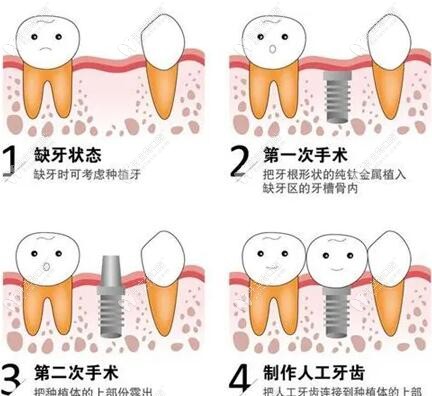 种植牙一期和二期要3个月进行二次种牙手术