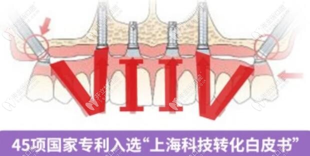 VIIV穿颧穿翼板种植牙技术优势
